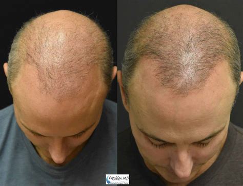 precision medical hair|Hair Loss Treatment Options .